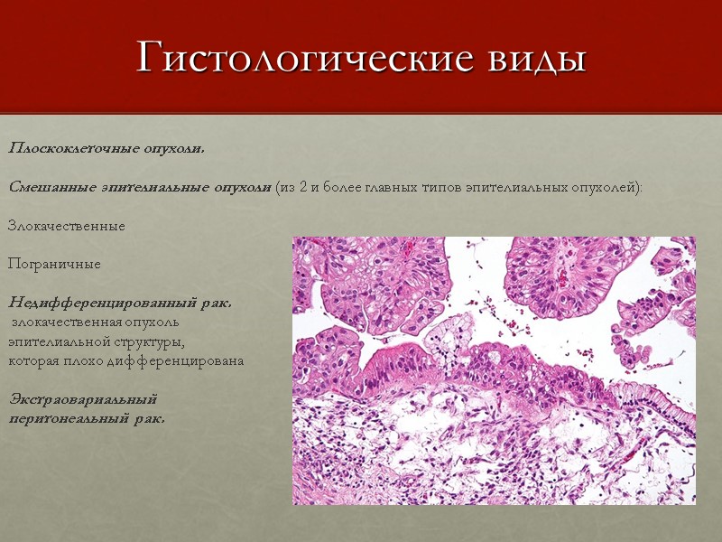 Гистологические виды Плоскоклеточные опухоли.   Смешанные эпителиальные опухоли (из 2 и более главных